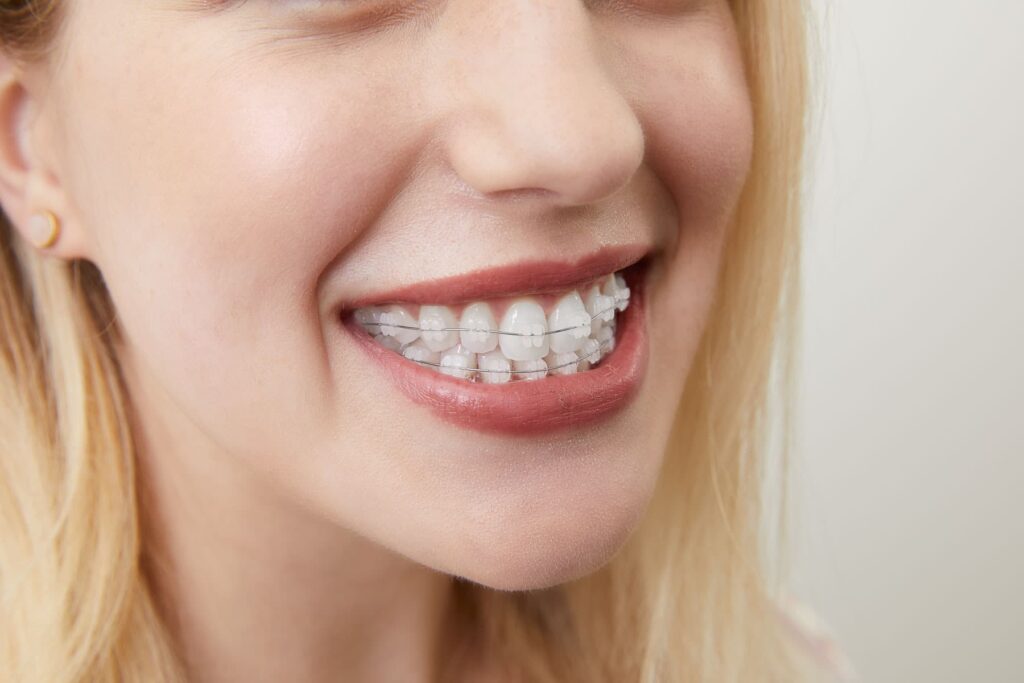 Bilde av kvinne som smiler med tradisjonell tannregulering med keramiske braketter.