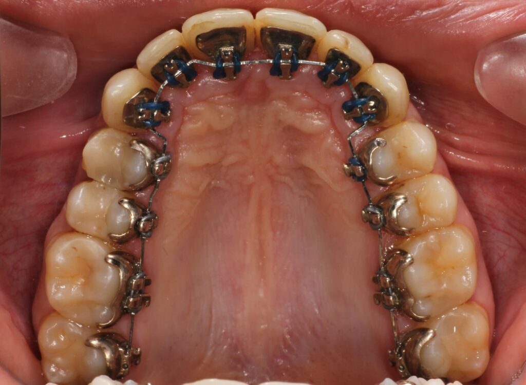 Bilde av baksiden av tenner med lingual tannregulering.